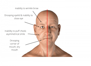 TCM Acupuncture Help in Treating Facial Nerve Paralysis -
