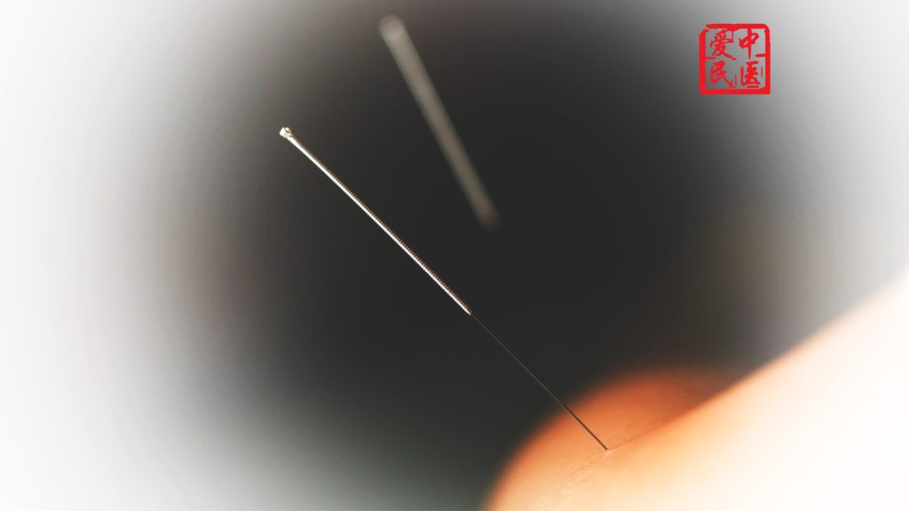 tcm weight loss Acupuncture
